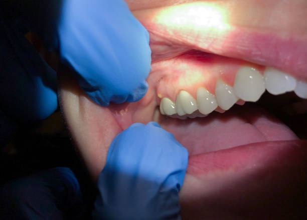 Best Emergency Tooth Extraction in Falmouth Foreside, ME
